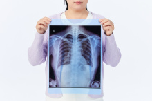 矽肺伤残鉴定标准是怎样