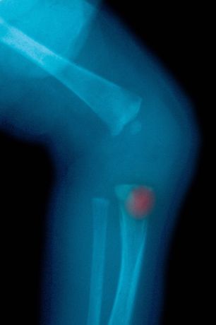 髌骨粉碎性骨折能赔偿多少钱